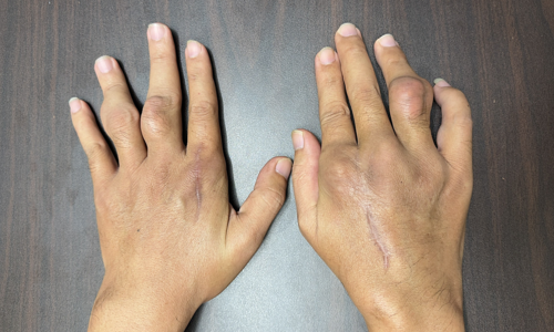 Sống chung bệnh gout từ tuổi đôi mươi