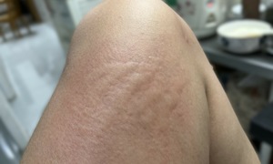Insect sting allergy and vaccinations