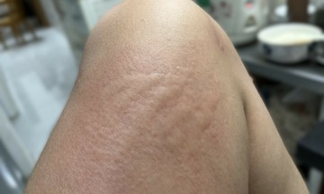 Bị dị ứng khi côn trùng đốt, có được tiêm vaccine?