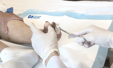 Sấy nóng chữa tiểu đường gây biến chứng hoại tử chân