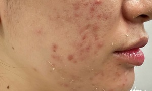 Hormonal acne versus regular acne