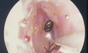 Five ticks removed from 9-year-old girl's ears