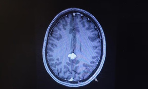 Living with an inoperable brain tumor