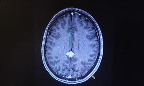 Living with an inoperable brain tumor