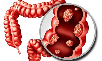 Bệnh nhân 31 tuổi chia sẻ dấu hiệu 'ẩn' của ung thư ruột