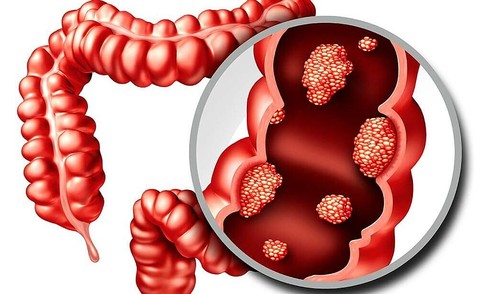 31-year-old shares 'hidden' sign of bowel cancer