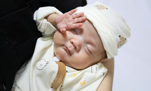 Premature baby weighing 550 grams survives after 100 days of intensive care