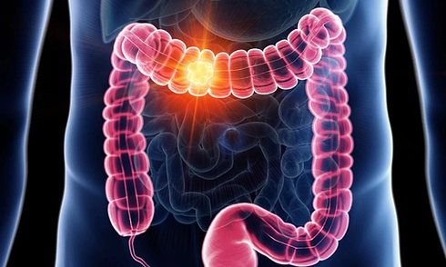 Rectal bleeding reveals cancer diagnosis