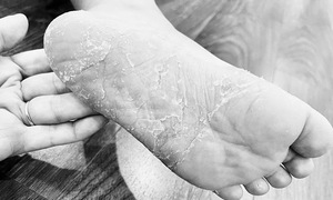 Four common skin problems after floods