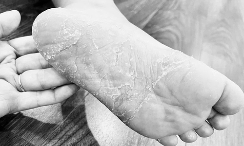 Bốn bệnh về da dễ gặp sau mưa lũ