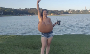 The ordeal of a woman with 12 kg breasts