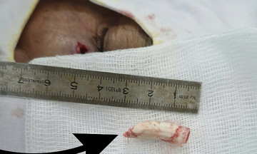 Cựa gà trống 2,8 cm đâm sâu vào mặt người đàn ông