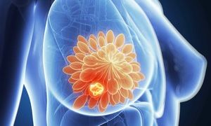 Breakthrough discovery in preventing breast cancer metastasis