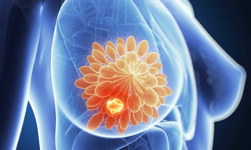 Breakthrough discovery in preventing breast cancer metastasis