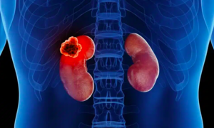 Kidney cancer: a silent killer