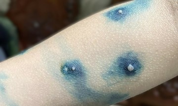 Bôi nước cây nhọ nồi có trị được thủy đậu?