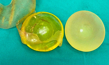 Vỡ túi ngực silicon