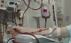 Should I undergo blood filtering to prevent high cholesterol?