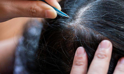 Vì sao mới 20 tuổi tóc đã bạc?