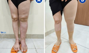 Lymphedema after cervical cancer treatment
