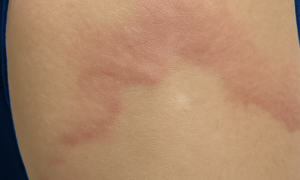 Chronic hives allergy