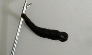 Leech found living in teenager's nose for 10 days