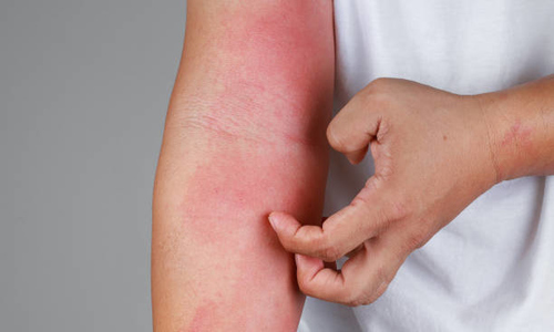 Man's decade-long itch diagnosed as rare lymphocytoma
