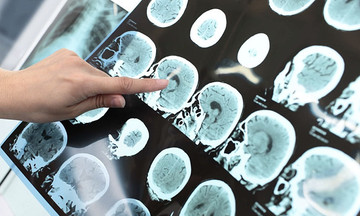 Ai dễ bị đột quỵ?