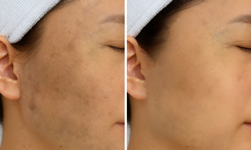 Hết đốm nâu trên mặt sau một năm điều trị