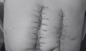 Genetic disorder revealed as cause of man's seven colon surgeries
