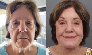 78-year-old woman's journey to reclaim her youth