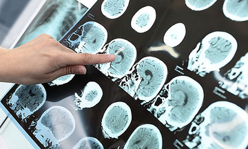 'Sát thủ' giấu mặt trong ADN gây đột quỵ ở người trẻ