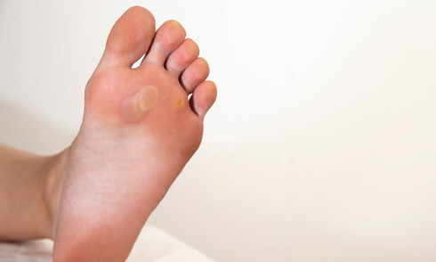 Are foot warts the same as genital warts?