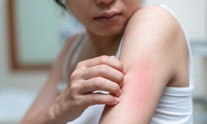 Recommended vaccines for frequent mosquito bites