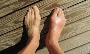 7 warning signs of high uric acid