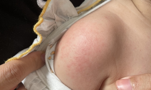 How does Chikungunya affect children?