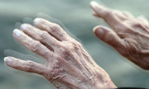Common movement disorders in Parkinson's disease