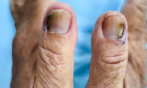 50 years with nail fungus
