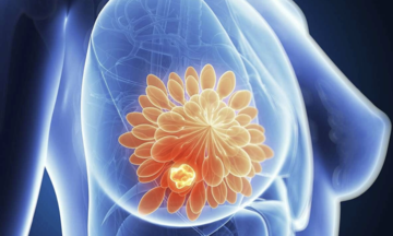 AI diagnoses lung and breast cancer with near-perfect accuracy