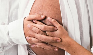 Thermage FLX: A solution for post-pregnancy stretch marks