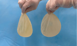 87-year-old woman has breast implants removed after 40 years