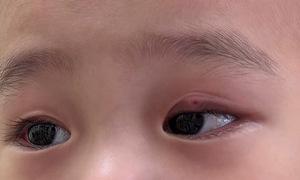 Toddler's eye swells shut due to staphylococcus aureus infection