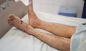 Man nearly dies after preparing raw pork