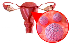 Over 2,500 Vietnamese women die each year from cervical cancer
