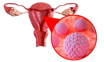 Over 2,500 Vietnamese women die each year from cervical cancer