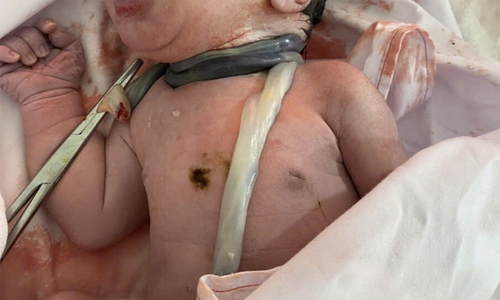 Baby born with umbilical cord wrapped around neck six times