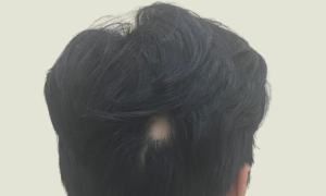Hair loss at 17