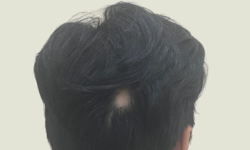 Hair loss at 17