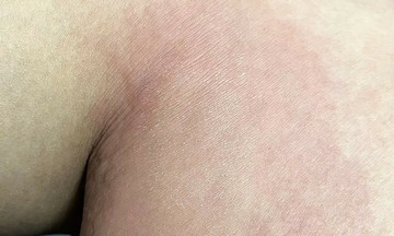 Does a mosquito bite cause Japanese encephalitis?