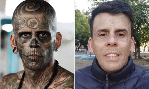 Tattoo removal: From 'circus freak' to a new life